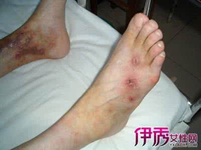 血管炎最好的治疗方法 血管炎的症状 血管炎的治疗方法是什么