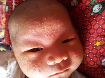 新生儿脸上长小红点图 新生儿脸上有小红点怎么办