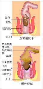 便秘的原因和治疗方法 治疗便秘最快的方法 便秘的治疗方法都包括哪几种
