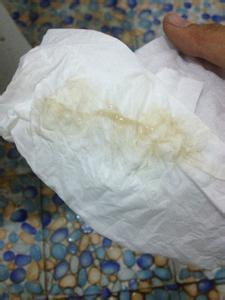 白带发黄怎么调理身体 白带发黄怎么办