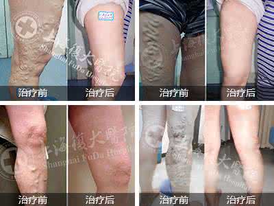 静脉曲张饮食注意 静脉曲张怎么办 通过饮食来缓解静脉曲张