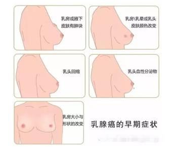乳腺癌早期症状会疼吗 乳腺癌早期症状 乳腺癌的预防与治疗