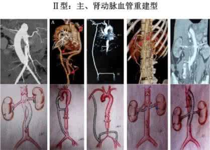 多发性大动脉炎症状 多发性大动脉炎 它的症状有哪些