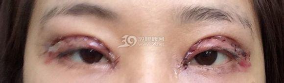 红霉素眼膏可以涂脸吗 红霉素眼膏可以涂脸吗？