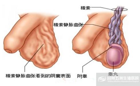 精索静脉曲张症状表现 精索静脉曲张症状表现 精索曲张症状有哪些？9大表现不容忽视