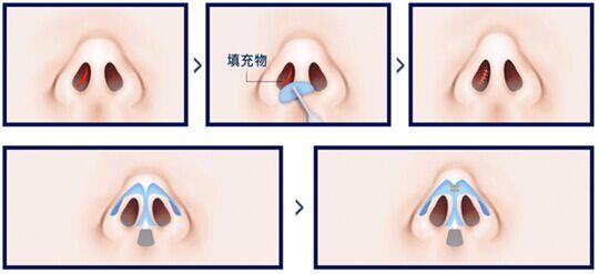 假体丰胸李朕在线咨询 假体丰胸手术的过程 你必须了解的丰额手术过程