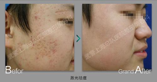 dermatix疤痕膏 疤痕无敌膏,一周后彻底治愈文档