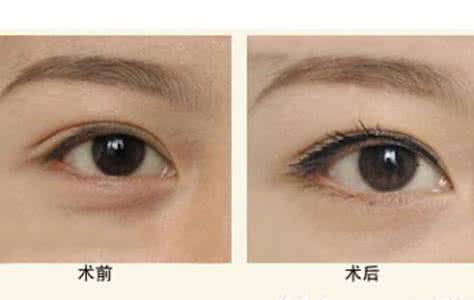 超声波去眼袋要多少钱 超声波去眼袋要多少钱 去眼袋大约多少钱
