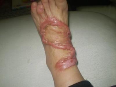 疤痕增生治疗方法 疤痕增生 疤痕增生常见治疗方法有哪些