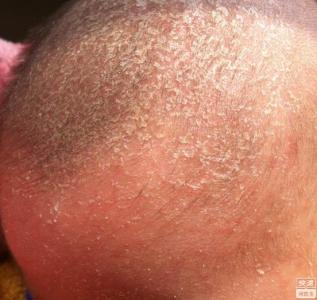 婴儿头癣 婴儿头癣擦什么药？