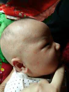 宝宝哭闹后脸上起湿疹 宝宝湿疹哭闹怎么办 湿疹不是病，不再闹人心！