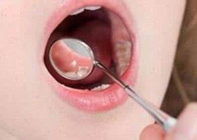 口腔白斑的症状 口腔癌 白斑 口腔白斑可变口腔癌 口腔癌的症状