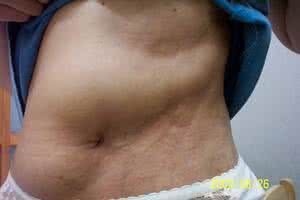 艾炙肚脐后的排湿反应 73脐湿、脐疮