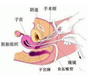 人流手术后多久来月经 人流后应该怎么过性生活:人流手术后多久来月经