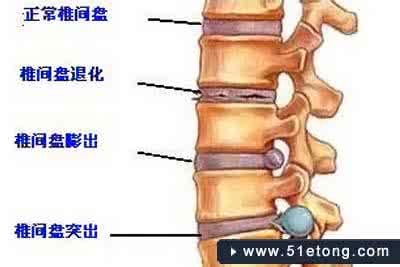 腰椎间盘突出症康复 腰椎间盘突出症治疗 人们需要熟知腰椎间盘突出的治疗方法