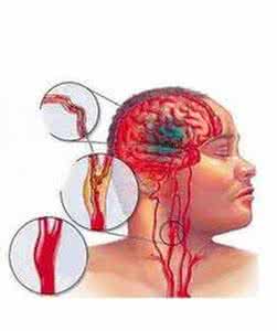 腔隙性脑梗塞能治愈吗 一周治愈脑梗塞