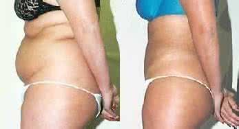 减大肚腩可以抽脂吗 减大肚腩可以抽脂吗 什么器械可以减肚腩？