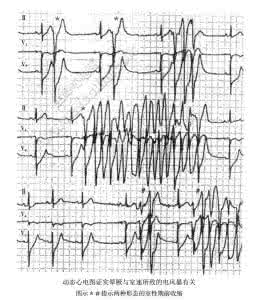 心室电风暴 心室电风暴综合征（ICD、交感风暴）