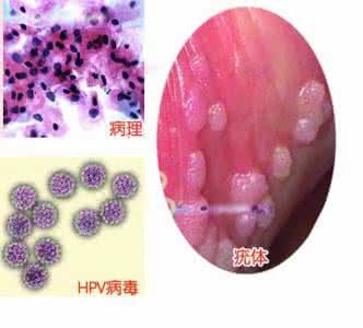 人乳头瘤病毒怎么得的 人乳头瘤病毒 它的类型有哪些