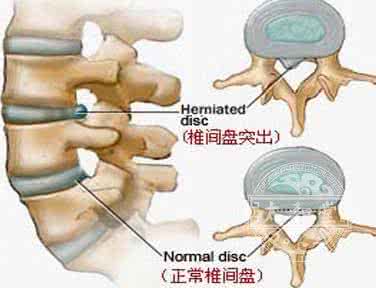 科学与艺术相结合实例 腰间盘突出的预防 科学的预防和科学的治疗相结合治疗腰间盘突出