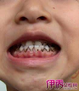 小孩牙齿有黄斑 小孩牙齿有黄斑 小孩牙齿黄斑是什么原因？