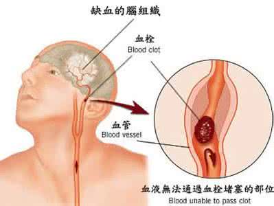 脑梗塞后遗症 脑梗塞后遗症，手指麻木怎么办？从这个经方聊起！