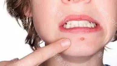 祛痘好习惯，杜绝它“痘”留！！！