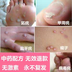 扁平疣感染病因分析 扁平疣感染病因分析 早产的病因分析