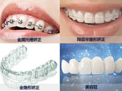 牙齿矫正有哪些方法 牙齿矫正方法有哪些?
