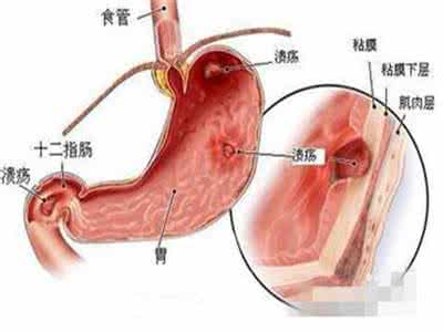 喝酒胃穿孔 喝酒怎么胃穿孔？