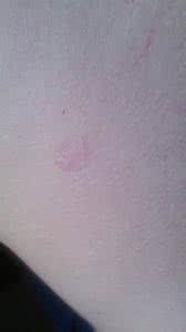 玫瑰糠疹该怎么治疗 玫瑰糠疹怎么引起的 玫瑰糠疹有什么症状