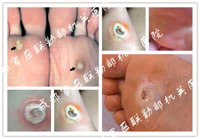 风油精治鸡眼小窍门 风油精治鸡眼小窍门 风油精治鸡眼 操作流程竟如此简单