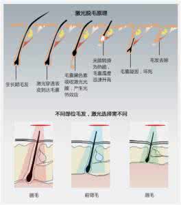 激光脱毛的原理 激光脱毛原理 激光脱毛技术原理详解