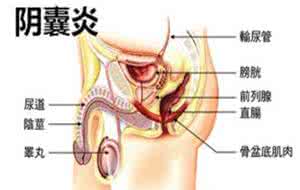 阴囊湿疹的治疗方法 治疗阴囊湿疹的方法 阴囊损伤的治疗方法