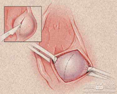 阳萎怎么治疗方法 巴氏腺囊肿怎么治疗 它的治疗方法有哪些