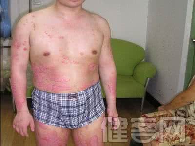 孕妇有脚气怎么办 孕妇有牛皮癣怎么办？