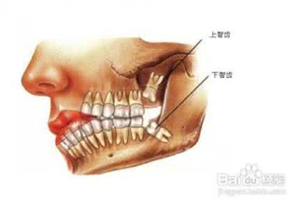 智齿发炎疼痛怎么办 智齿疼 智齿疼痛怎么办 精