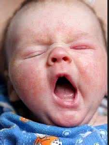 新生儿湿疹的治疗方法 新生儿湿疹是什么 湿疹患者的治疗方法是有什么