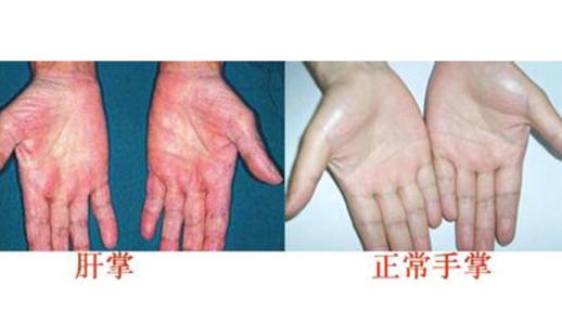 肝病患者症状 肝病有哪些症状 这4类人容易患肝病