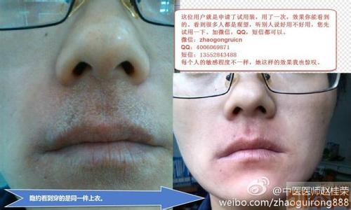 脸部激素性皮炎 脸部激素性皮炎怎么治 激素脸（激素皮炎）怎么治？