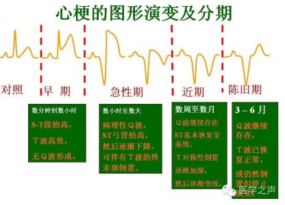 心电图心梗定位记忆图 心梗心电图定位 教你快速识别心梗定位 ！