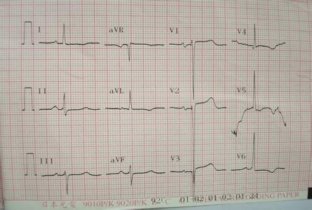 心肌梗死心电图表现 一图详解：心肌梗死的心电图表现