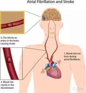 房颤诊断标准 一文读懂房颤的诊断与治疗！