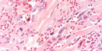 阴茎 珍珠状丘疹 阴茎珍珠状丘疹 它的危害大吗