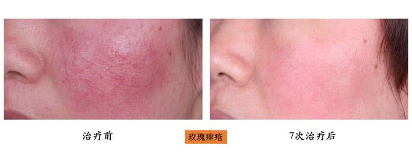 皮肤过敏症状及治疗 皮肤过敏症状及治疗是什么