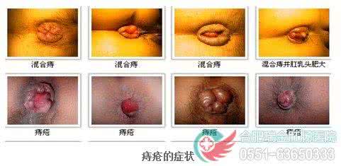 痔疮治疗方法 自己治疗痔疮的方法 这些食材治痔疮