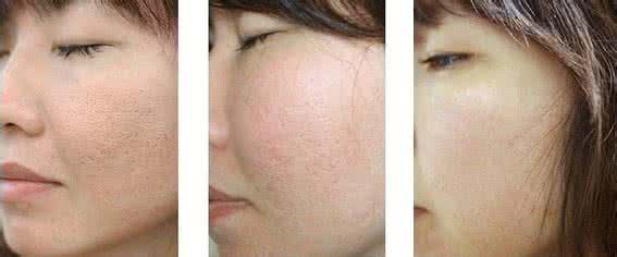 毛孔粗大吃什么水果好 毛孔粗大多吃番茄！