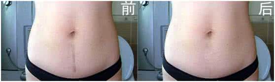 剖腹产疤痕可以去除吗 剖腹产疤痕去除 剖腹产疤痕可以去除吗？