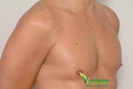 男性乳房肿块的防治 男性乳房肿块的防治 男性乳房有肿块是怎么回事