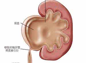 肾盂积水 不传秘方：右肾盂中度积水一月痊愈理气行水汤